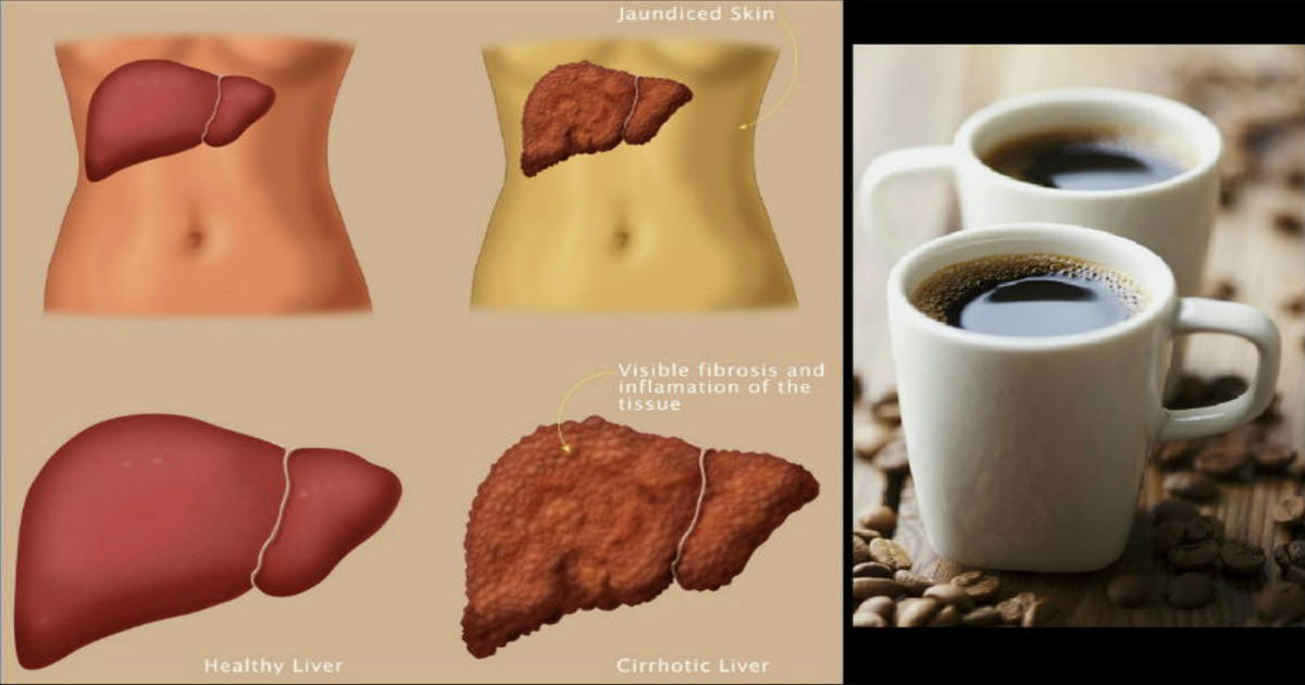 Drink Coffee To Protect And Reverse Liver Damage Caused by Alcohol