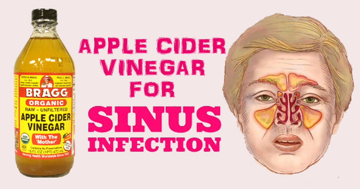 5 Ways To Use Apple Cider Vinegar For Sinus Infection DailyHealthPost