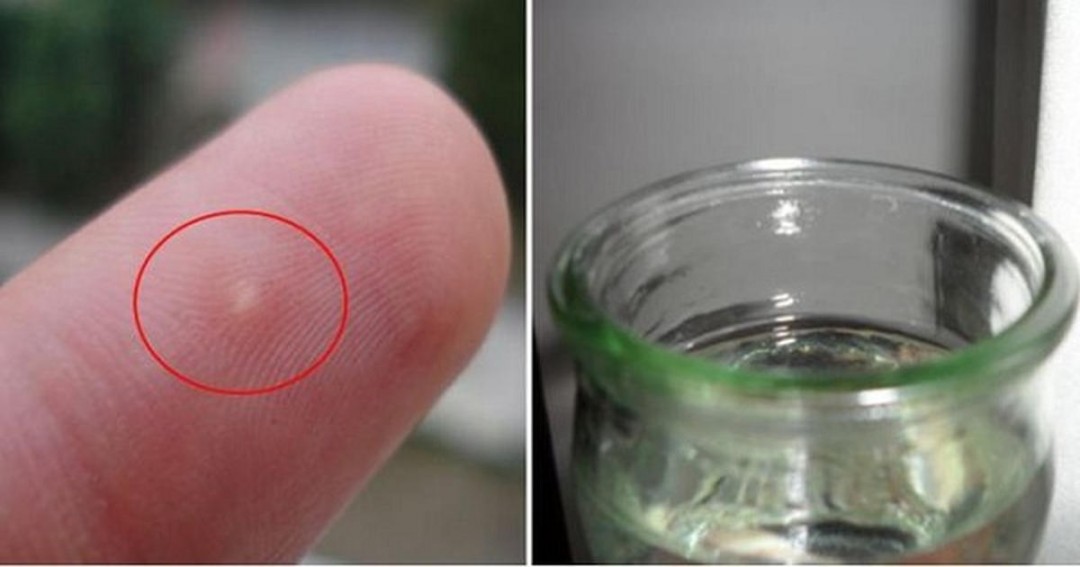 Painless Trick To Remove Stubborn Splinters In Your Skin Using Only A ...