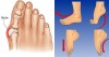 How To STOP The Progression Of Your BUNION With These 5 Natural Techniques