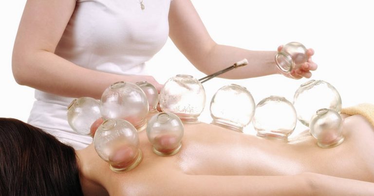 cupping therapy
