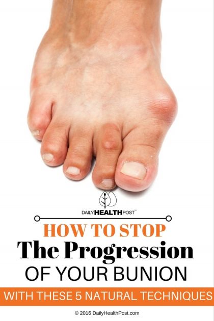 How To STOP The Progression Of Your BUNION With These 5 Natural Techniques