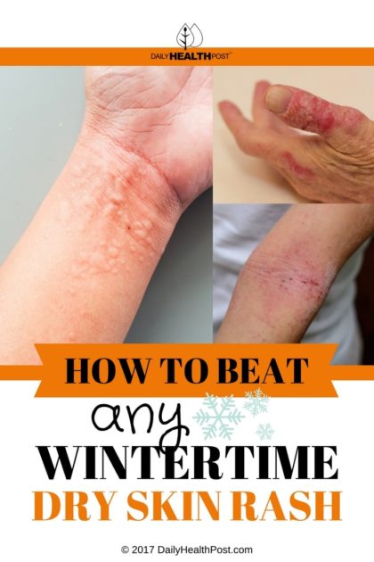 12 Home Remedies To Beat Any Wintertime Dry Skin Rash