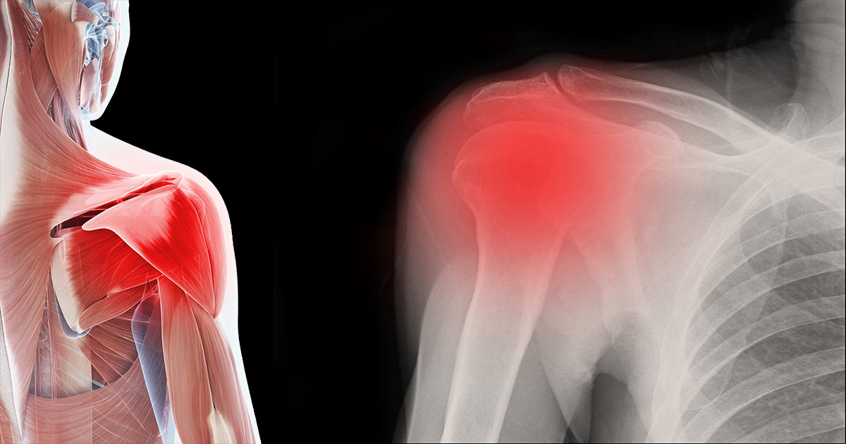 Best Frozen Shoulder Treatment Options for Lasting Pain Relief