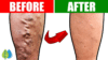 Top 5 Drinks To INSTANTLY Improve Leg Circulation And Blood Flow