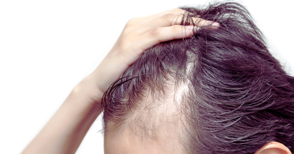 stop hair loss naturally